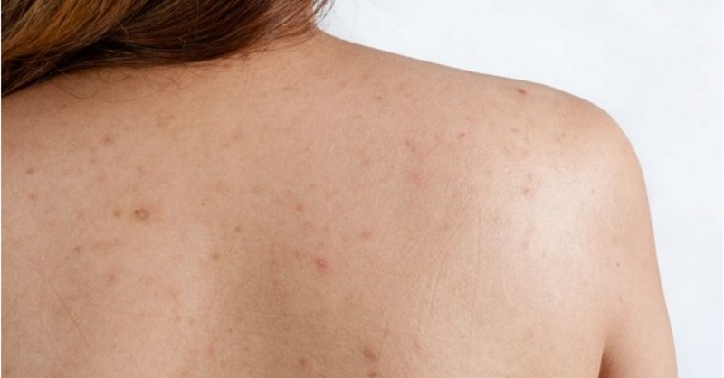 spa trị mụn lưng