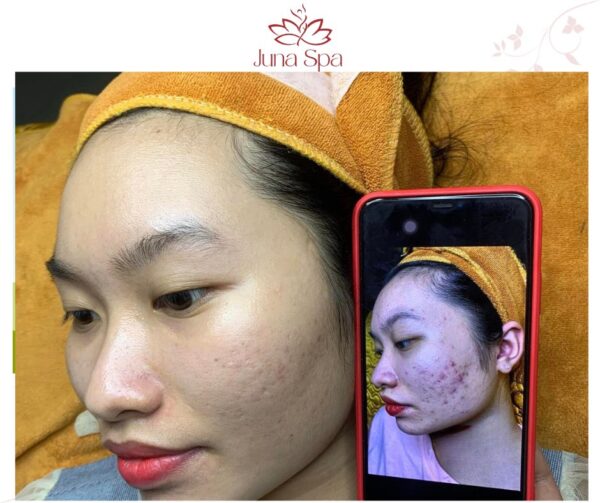 ưu điểm trị mụn theo công nghệ cell layer