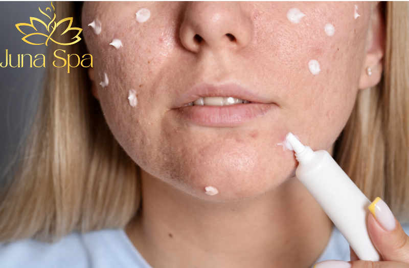 Không dùng kem đánh răng chấm mụn