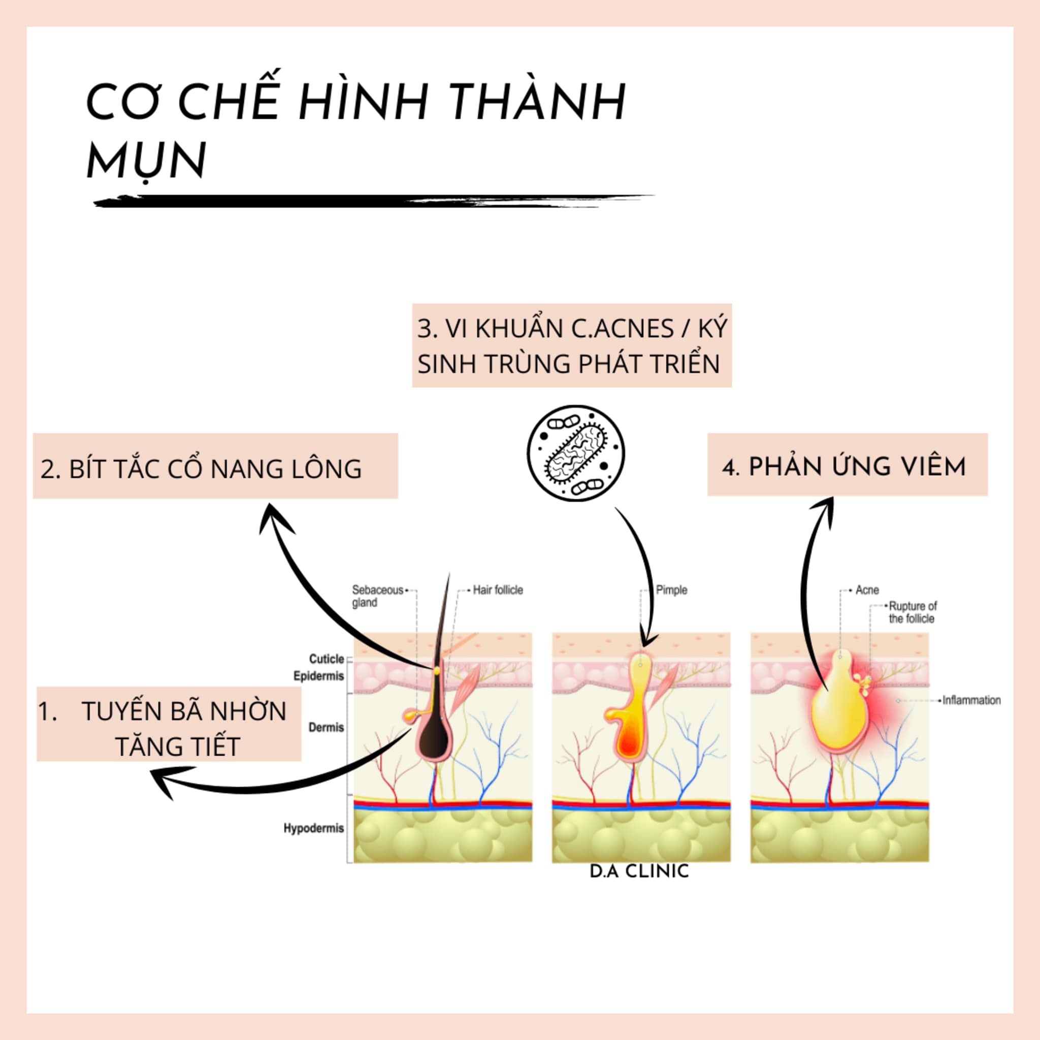 1. Cơ Chế Hình Thành Mụn 