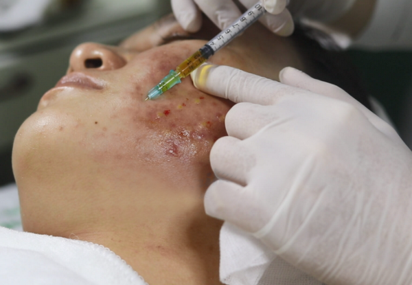 Tình trạng bội nhiễm sau tiêm Meso