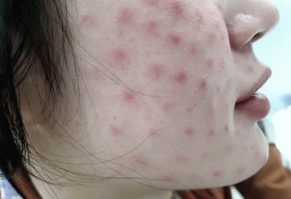 U giả hạt sau tiêm Meso