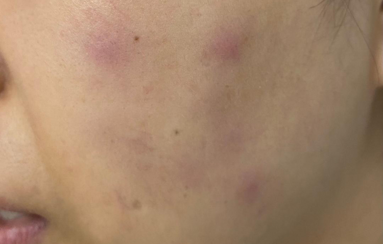 Nhiễm trùng sau tiêm Meso